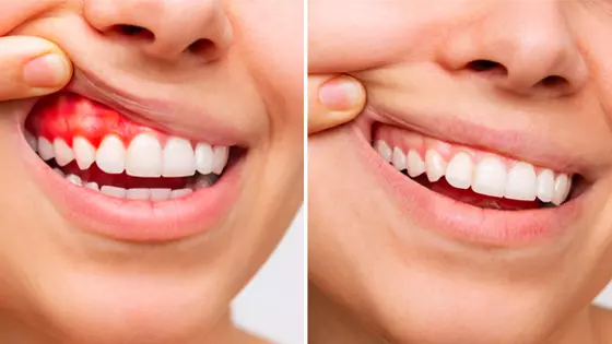 antes e depois de cirurgia de gengiva 