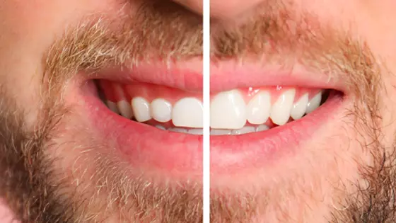 antes e depois da gengivoplastia 