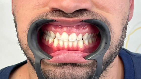 boca sendo aberta para dentes serem avaliados 