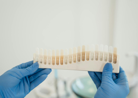 Dicas de higiene bucal para preservar suas facetas dentárias e manter o sorriso perfeito